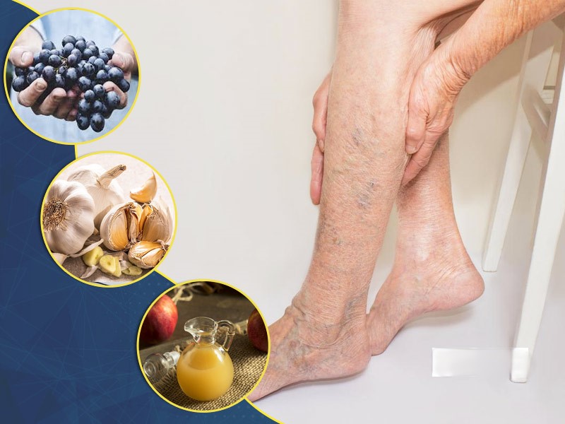 Overcoming Symptoms of Varicose Veins with Ayurveda