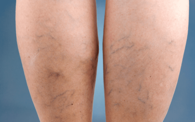 Reduce Symptoms of Varicose Veins