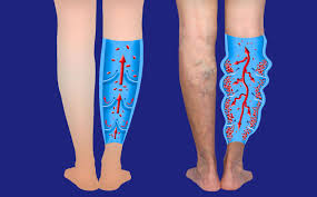 Mild Symptoms of Varicose Veins Early Signs You Shouldn't Ignore