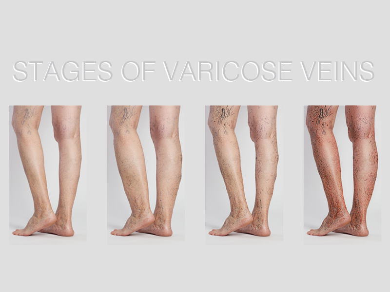 Learn how high cholesterol can aggravate varicose vein symptoms and what you can do to manage both conditions. Discover heart-healthy tips and diet changes to improve circulation and reduce inflammation.