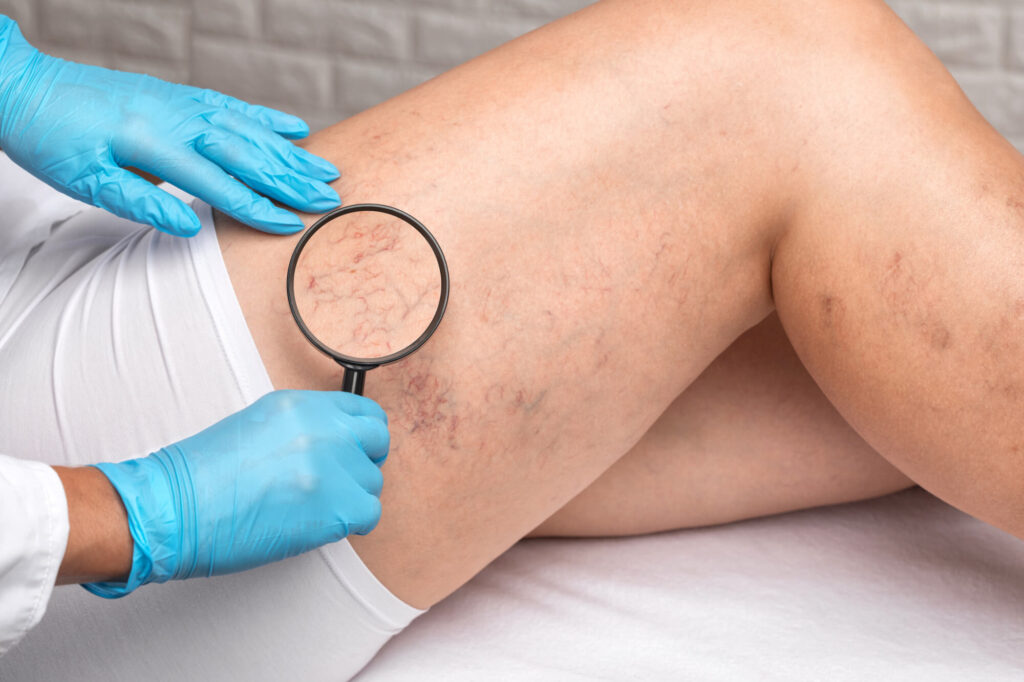 Early Stage of Varicose Veins