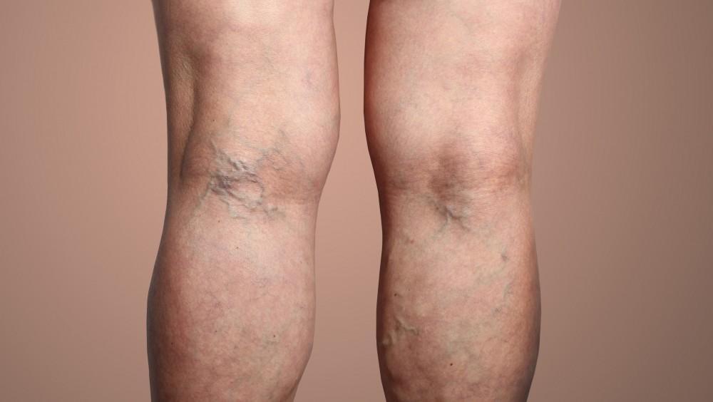 Throbbing and Burning Symptoms of Varicose Veins