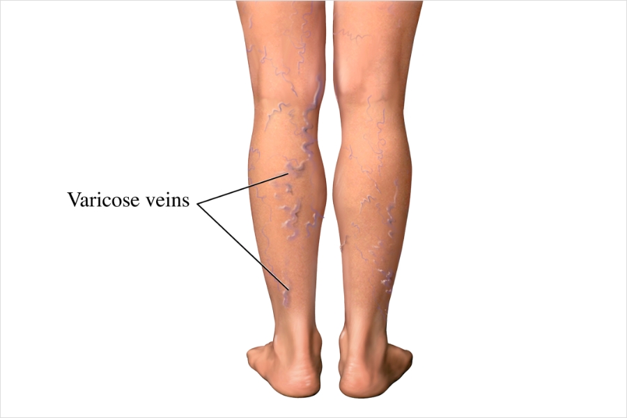 Being Inactive or Living a Lazy Lifestyle and Varicose Veins: Understanding the Connection