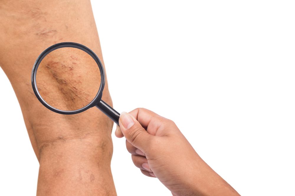 Learn how high cholesterol can aggravate varicose vein symptoms and what you can do to manage both conditions. Discover heart-healthy tips and diet changes to improve circulation and reduce inflammation.