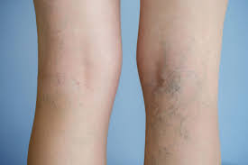 Varicose Veins and Skin Color Change