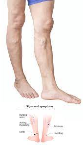 Throbbing and Burning Symptoms of Varicose Veins