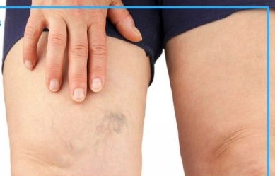 Can Topical Sprays Help Relieve Symptoms of Varicose Veins