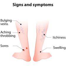 numbness is also a symptom of varicose vein