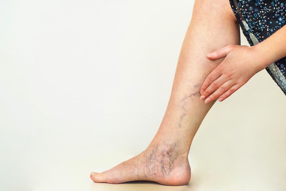 Does Cholesterol Aggravate Symptoms of Varicose Veins?