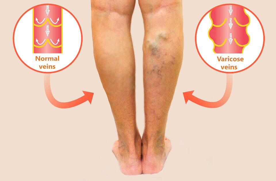 Tips and Tricks to Overcome Varicose Vein Symptoms