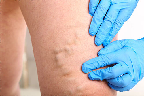 Can Males Also Feel Symptoms of Varicose Veins?