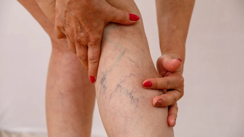 Do Varicose Vein Symptoms Worsen at Night?