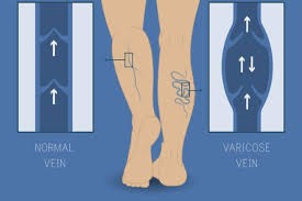 Manage Daily Discomfort from Varicose Veins Symptoms