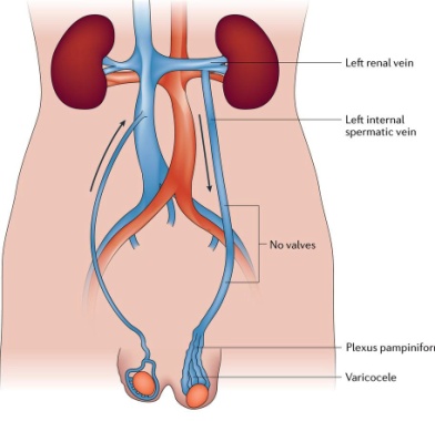 Can We See Symptoms of Varicose Veins With Varicocele?