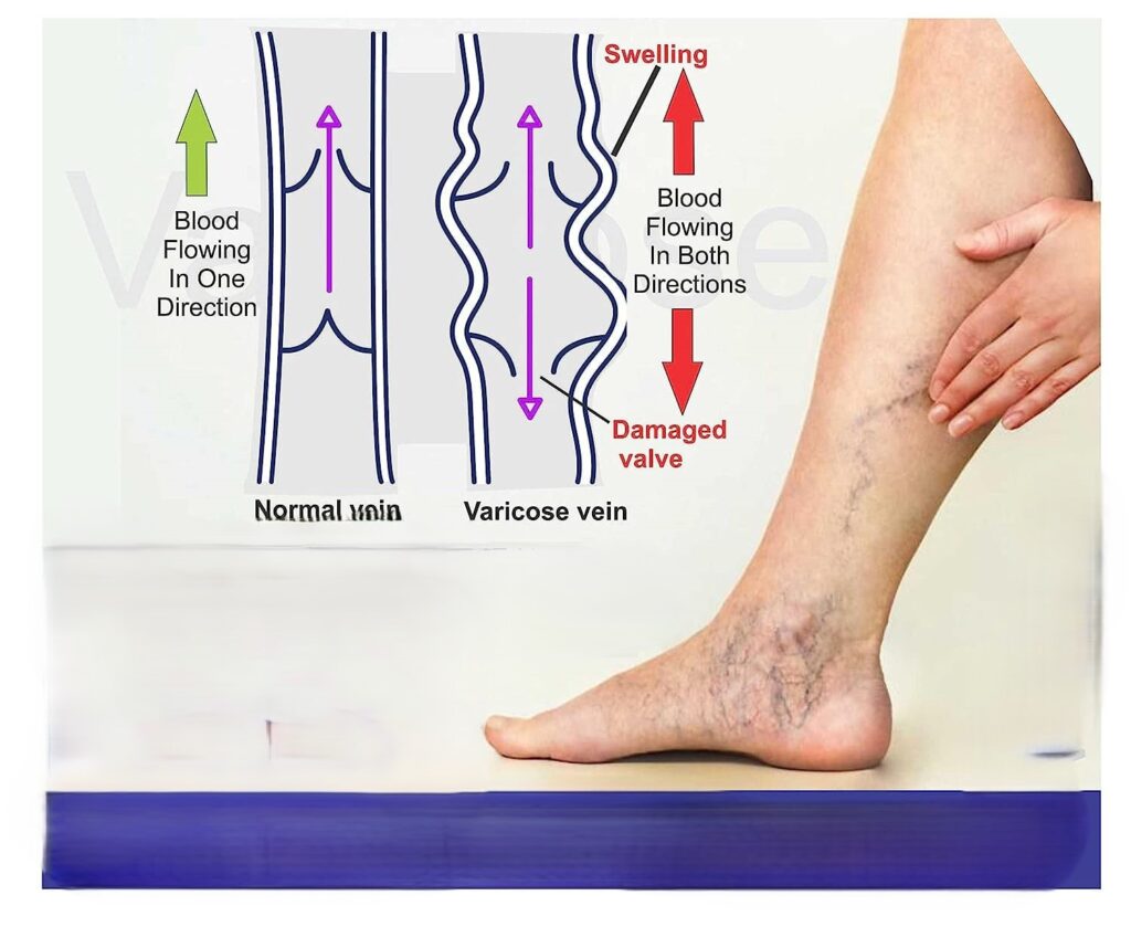 Does Butcher’s Broom Extract Really Work to Resolve Symptoms of Varicose Veins