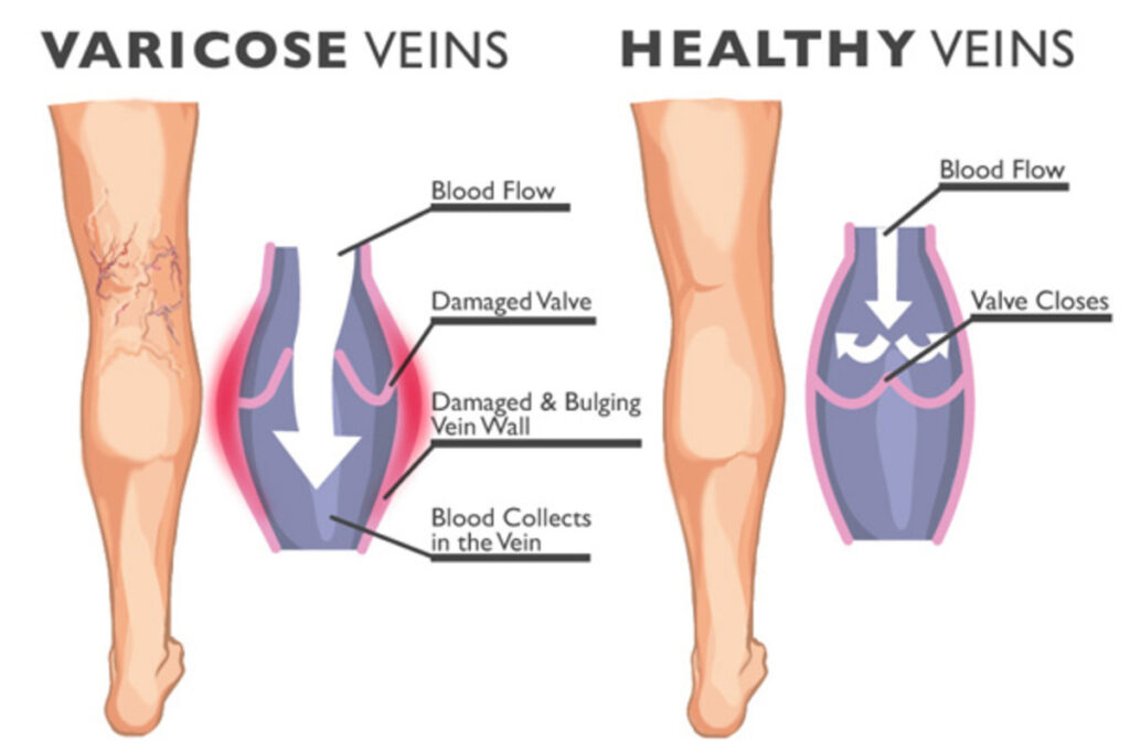 Does Butcher’s Broom Extract Really Work to Resolve Symptoms of Varicose Veins