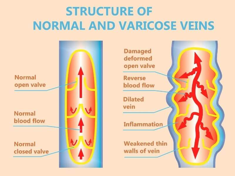 Fatigue and Heaviness: Key Symptoms of Varicose Veins