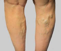 Home Remedies for Varicose Veins