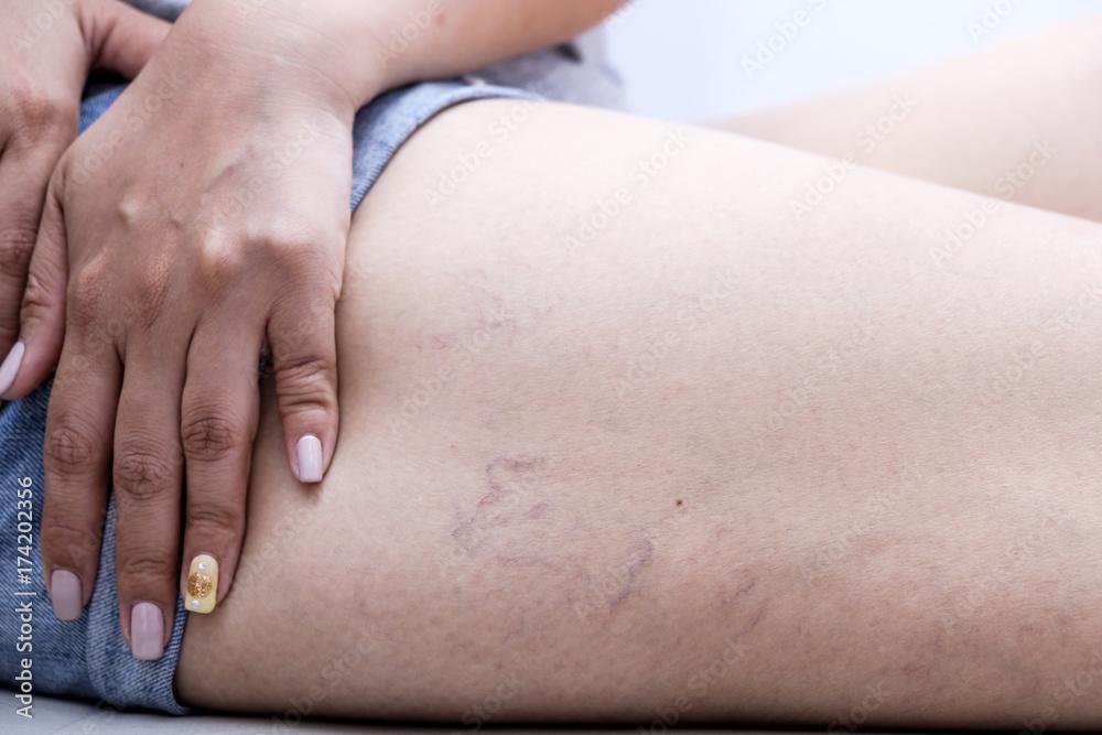 Symptomatic Varicose Veins