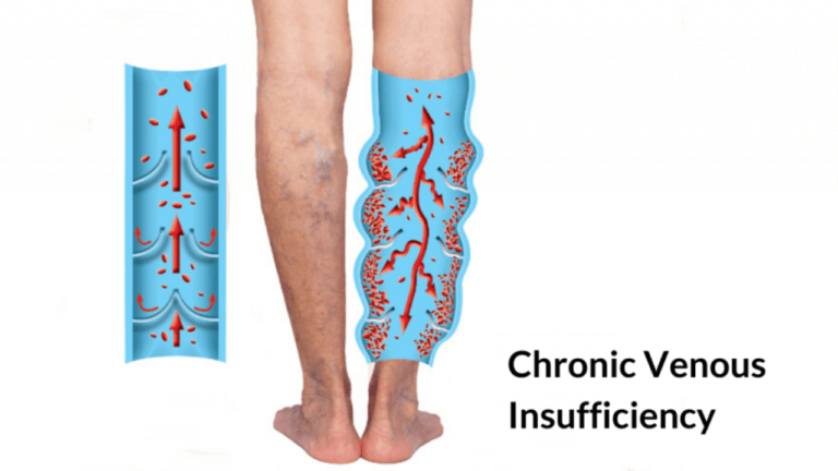 numbness is also a symptom of varicose vein