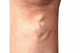 Are Varicose Vein Symptoms Easily Diagnosable