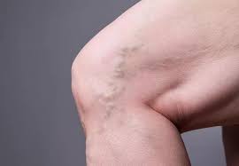 Mild Symptoms of Varicose Veins Early Signs You Shouldn't Ignore