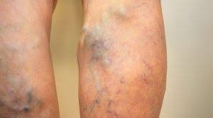 skin around varicose veins feel to touch