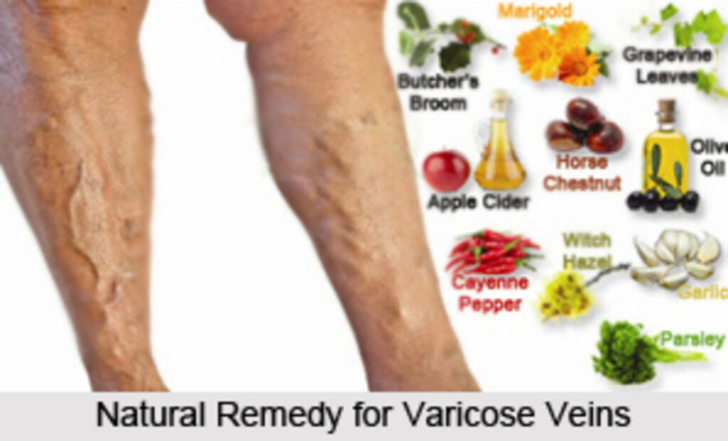 Symptoms of Varicose Veins Reverse Themselves Without Surgery