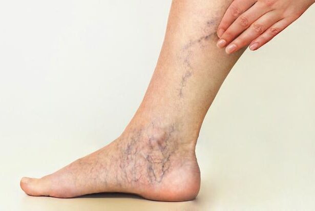 Symptomatic Varicose Veins