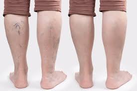 Symptoms of Varicose Veins Reverse Themselves Without Surgery