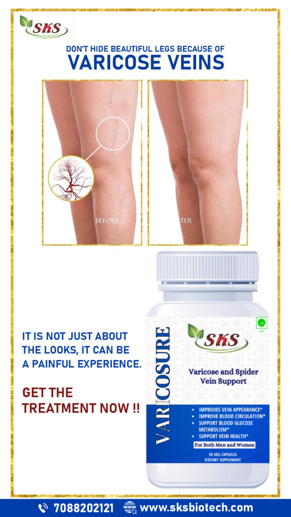 Varicose Veins Make Legs or Feet Warmer or Colder Than Usual