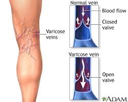 Varicose Veins Cause Ankle or Foot Swelling