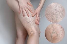 Lifestyle Factors Can Worsen Varicose Veins