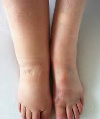 Varicose Veins Cause Ankle or Foot Swelling