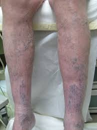 Varicose Veins Make Legs or Feet Warmer or Colder