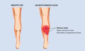 leg ulcers a common symptoms of advanced varicose veins