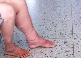 Lifestyle Factors Can Worsen Varicose Veins