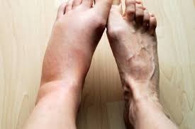 Varicose Veins Cause Ankle or Foot Swelling